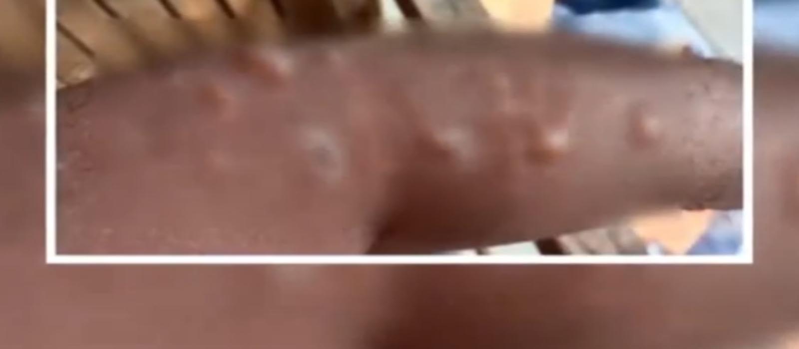 താനൂരിൽ യുവാവിന് സൂര്യാതപമേറ്റു